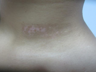 “细胞复色”疗法的疗效特征