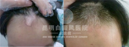头部白癜风有哪些特点?