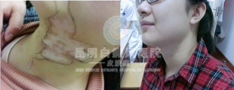 预防白癜风扩散的最好方法