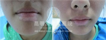 白癜风并非不治之症,应积极预防