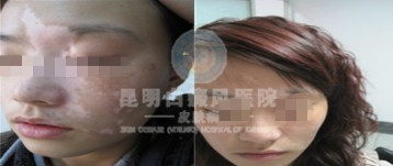 面部白癜风如何治疗?