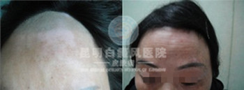 哪些调理可以预防白癜风