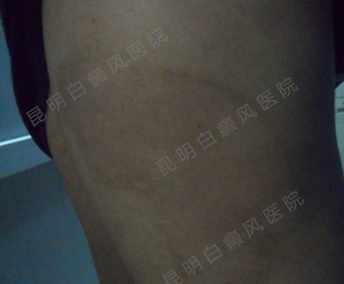 男性背部局限型白癜风5年