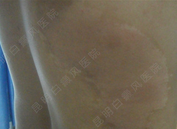 男性背部局限型白癜风5年