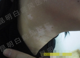 40岁女性颈部白癜风10余年