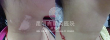 脖子上的白癜风为什么会复发?