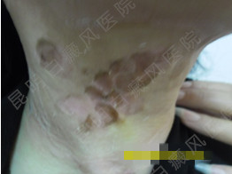 40岁女性颈部白癜风10余年