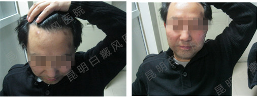 男性1年白癜风在我院3个月康复