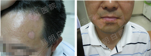 男性1年白癜风在我院3个月康复