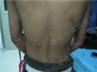 青少年背部白癜风2年