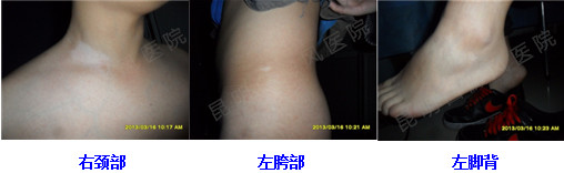 2年的白癜风在我院3个月治好