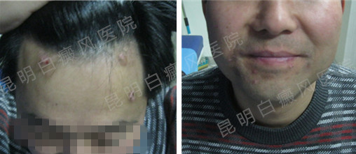 男性1年白癜风在我院3个月康复