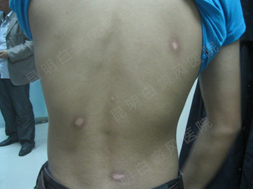 青少年背部白癜风2年