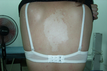 背部白癜风给患者带来的危害