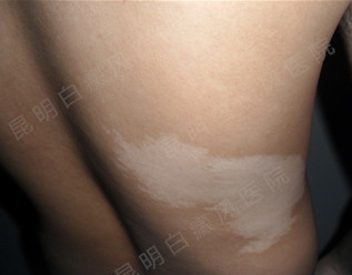 男性背部局限型白癜风5年