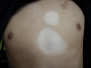 怎么诊断胸部白癜风?