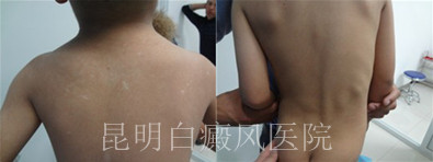 胸部白癜风的症状有哪些呢?