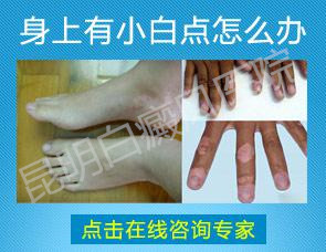 身上长白斑怎么回事,是什么病?怎么治?