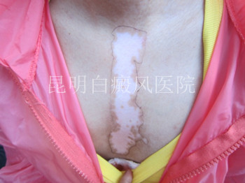 女性胸部白癜风怎样护理?