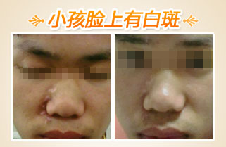 小孩脸上有白斑 家长不容忽视