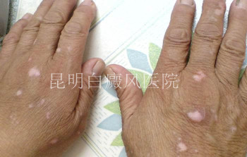肢端型白癜风为什么不好治?