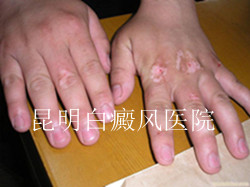 手部白癜风对患者的危害