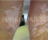 腿部出现白癜风的原因是什么