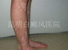 如何预防腿部白癜风扩散?