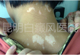 散发型白癜风向泛发型发展该怎样阻止?