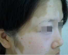 女性白癜风有哪些症状?