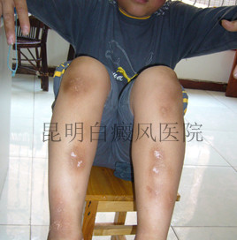 腿部有白斑该怎么办呢?