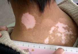 白癜风是由什么引起的?