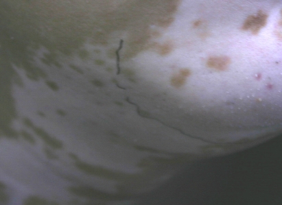 白斑是白癜风吗?