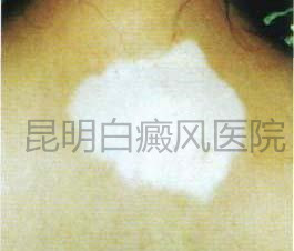 散发型白癜风患者需忌口