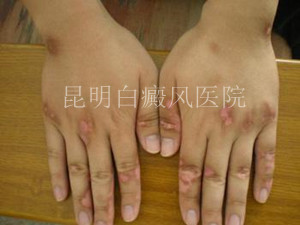 肢端型白癜风该怎么治?