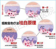 散发型白癜风向泛发型发展该怎样阻止?