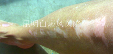 腿部白癜风的症状是什么?