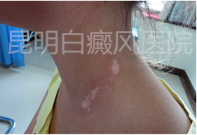 散发型白癜风日常注意事项?