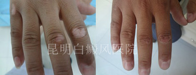 诊断肢端型白癜风有哪些要点