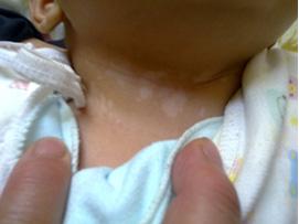 发生局限性白癜风的原因是什么?