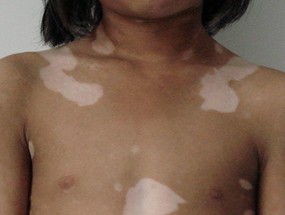 局限性白癜风怎么治疗?