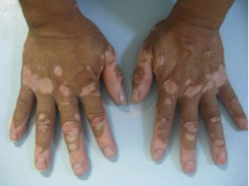 老年人治疗白癜风时的正确做法?