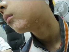 如何治疗局限性白癜风?