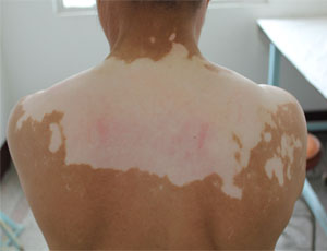 泛发型白癜风能治好吗?