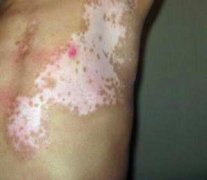 节段型白癜风的危害