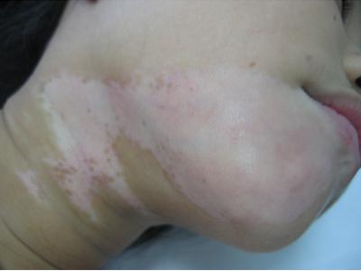 节段型白癜风介绍