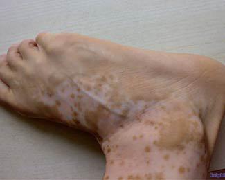 节段型白癜风有什么特殊性?