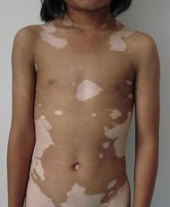 什么是泛发型白癜风