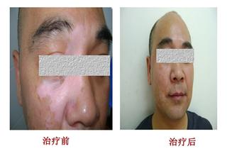 什么是节段型白癜风