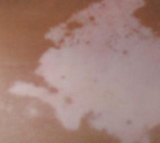 泛发型白癜风对儿童危害有哪些呢